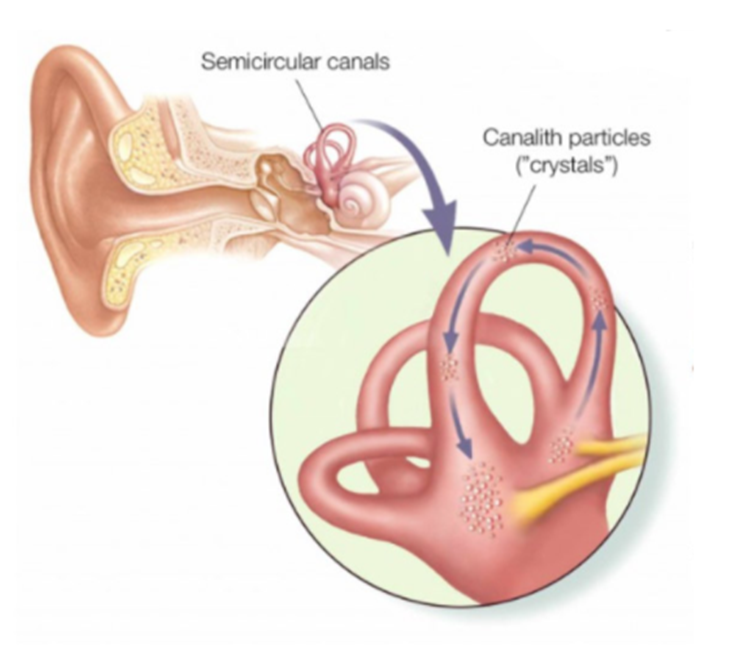 Positional Vertigo (BPPV) FAQs